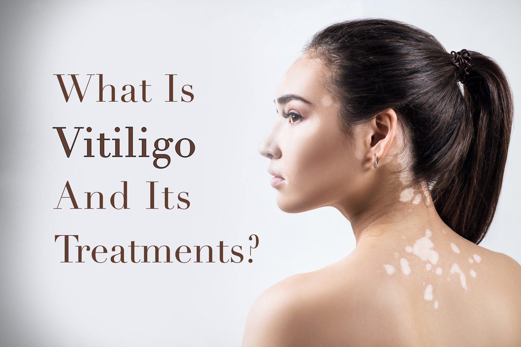 What Is Vitiligo And Its Treatment? | TatoyanMD Medspa