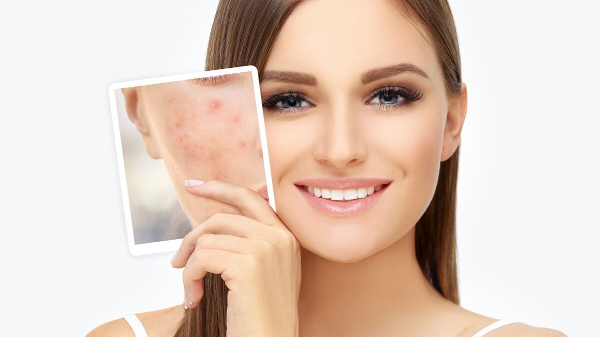 Acne Marks vs. Acne Scars: All Questions Answered