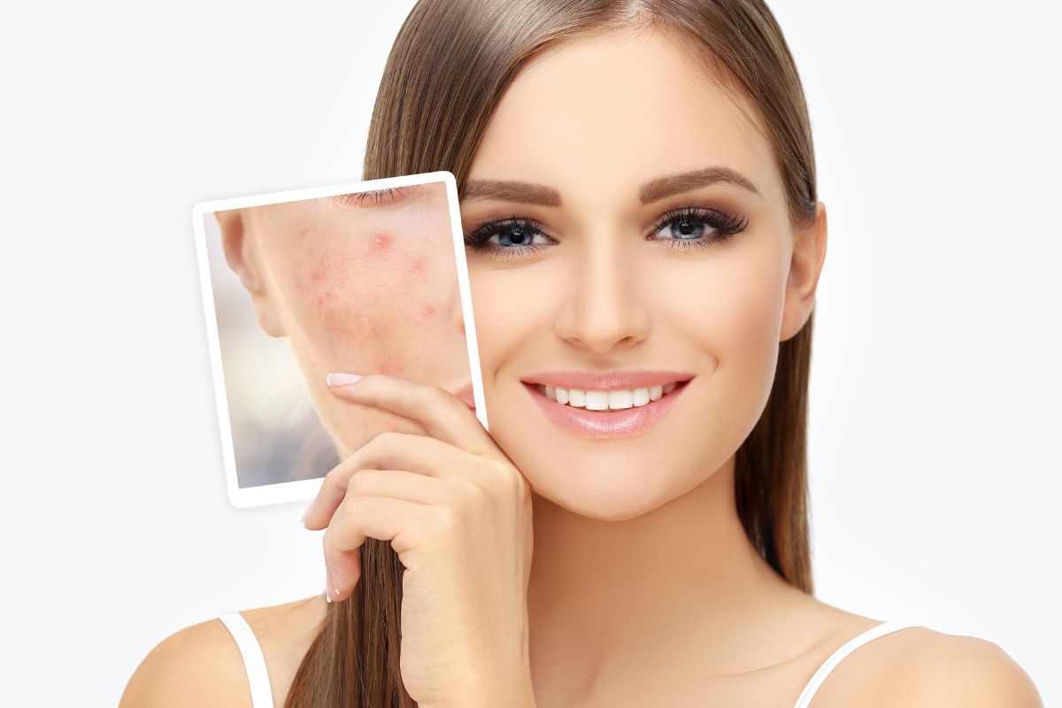 Acne Marks vs. Acne Scars All Questions Answered TatoyanMD Medspa