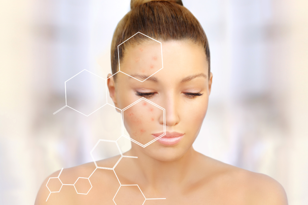 Benefits of Hydrafacial - treating acne