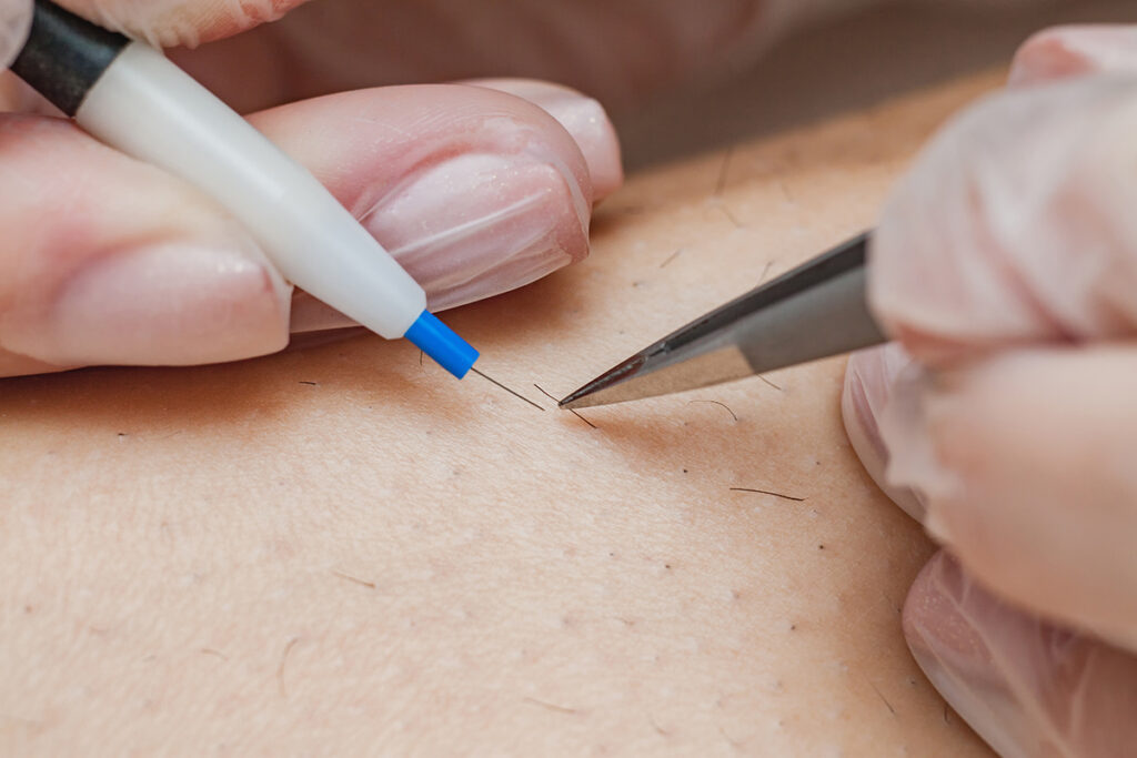 Electrolysis vs Laser Hair Removal- Conclusion for Dark Skin