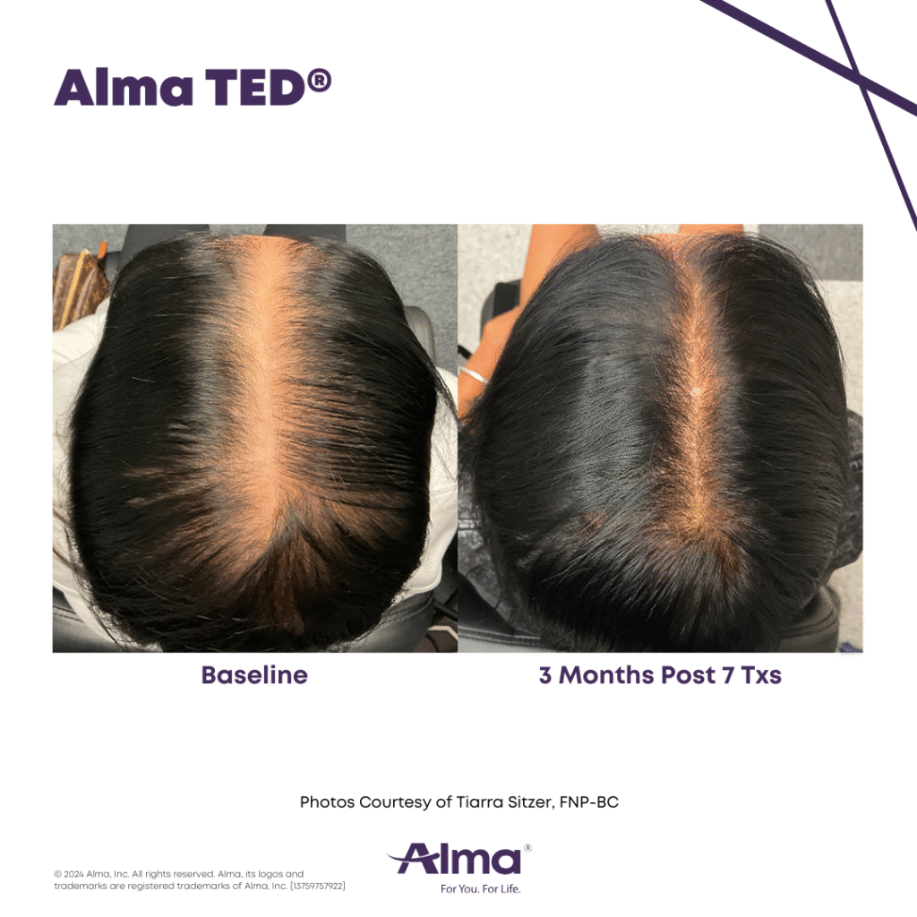 Alma TED Before and After