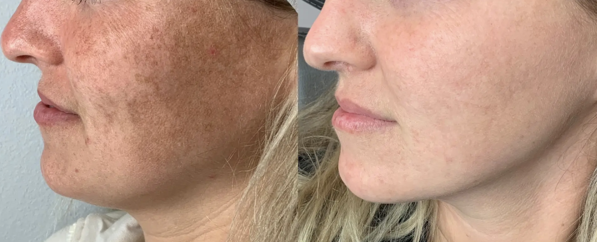 lumecca ipl before and after