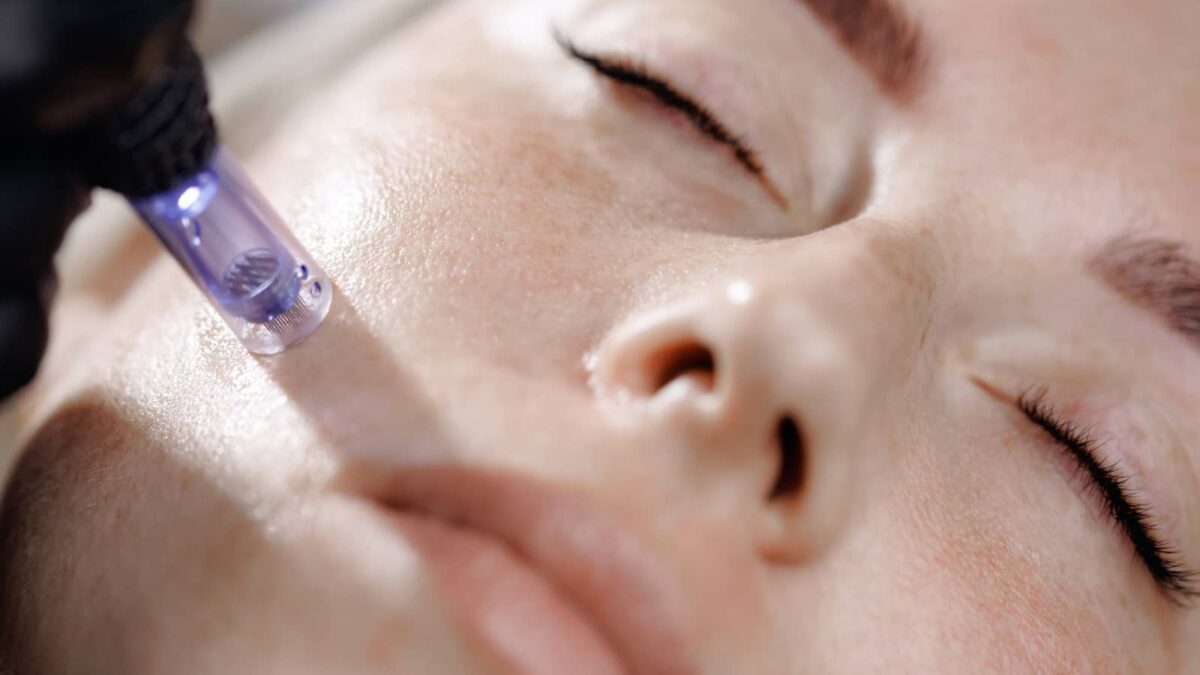 microneedling vs laser