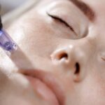 microneedling vs laser