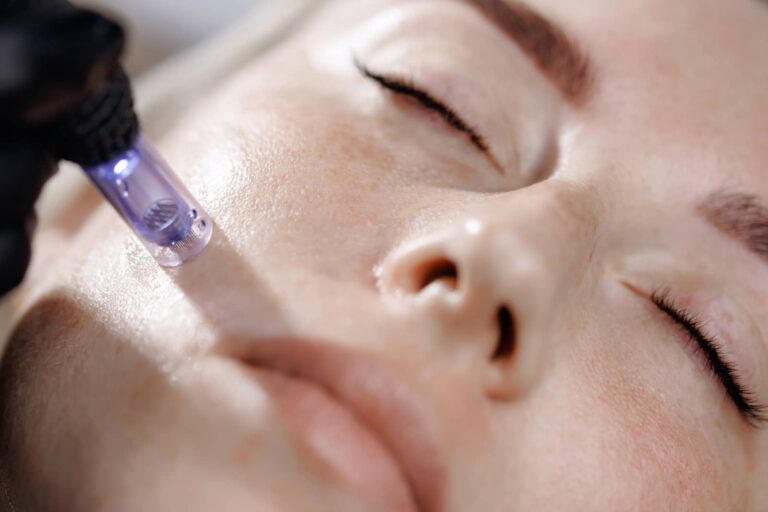 microneedling vs laser