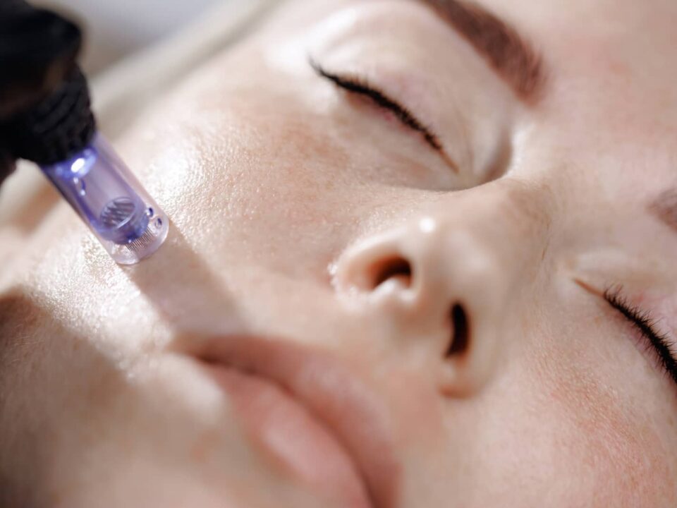 microneedling vs laser